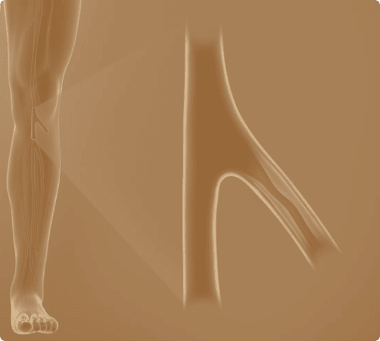 Medical illustration of a human leg with a close-up view of narrowed arteries, depicting peripheral artery disease (PAD) and restricted blood flow.