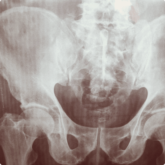 An X-ray image of the pelvis and lower spine, showing bone structure and alignment.