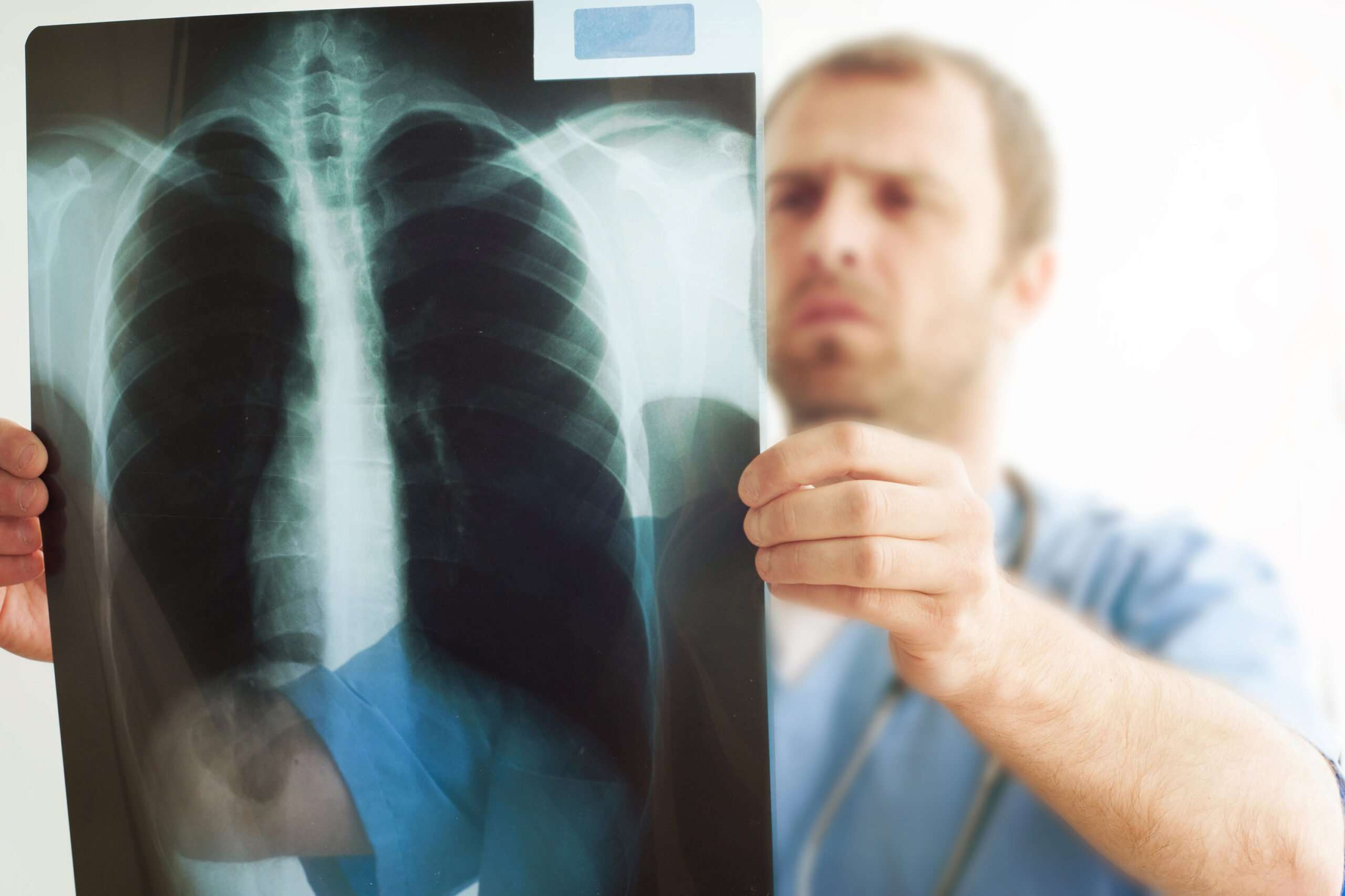 pulmonary nodules 